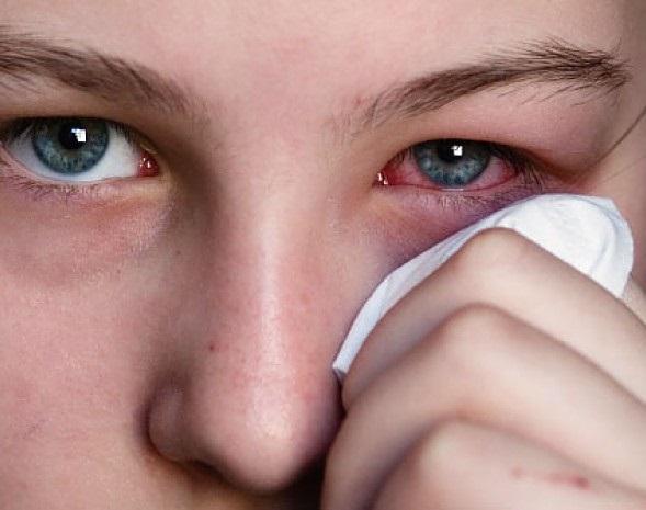 Por qué se Enrojecen los Ojos y Cómo prevenirlo