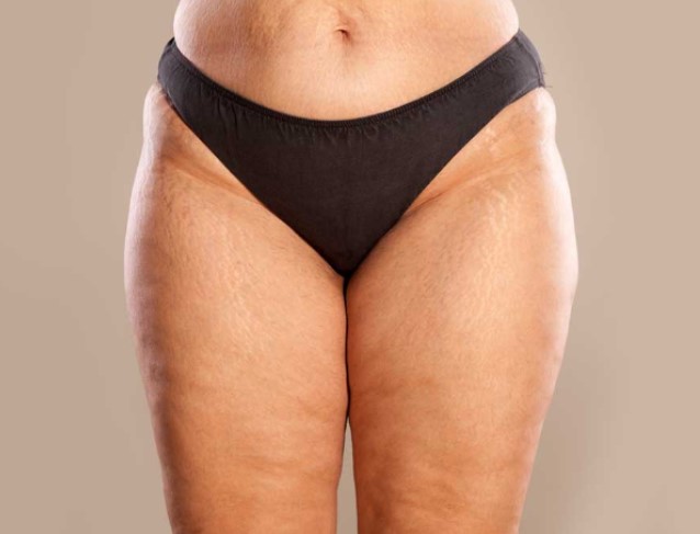 reducir la celulitis