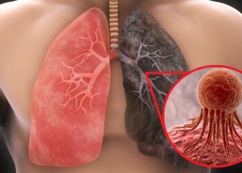 El cáncer de pulmón, paradigma de la medicina de precisión en Oncología