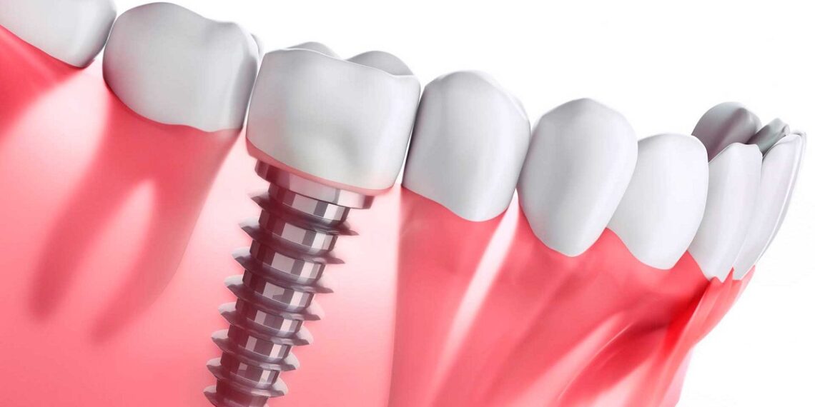 implantes dentales