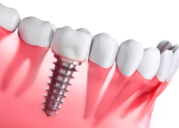 implantes dentales