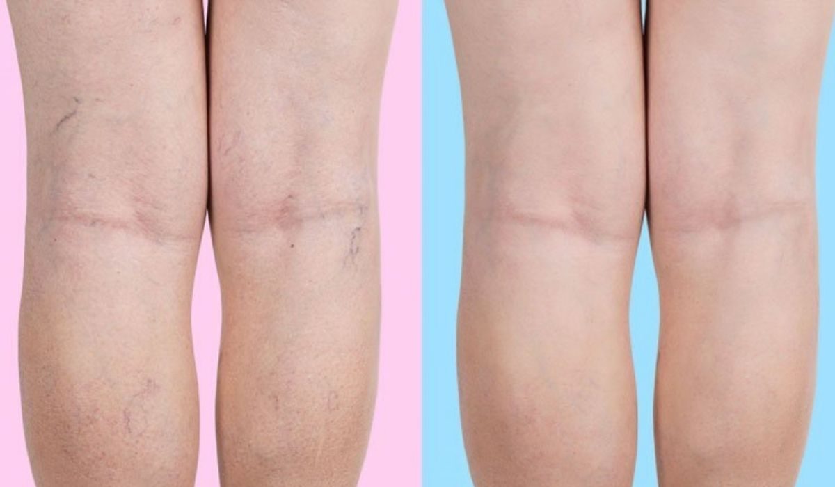 Como-eliminar-las-varices-de-las-piernas-naturalmente