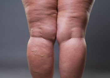 ¿Cómo prevenir varices naturalmente?