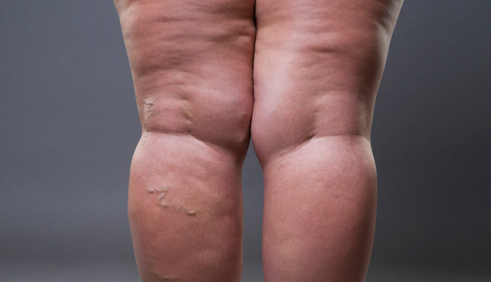 ¿Cómo prevenir varices naturalmente?