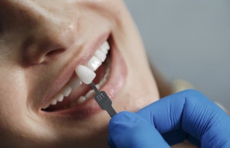 Las carillas no solo mejoran la estética, sino que contribuyen con la buena salud bucal