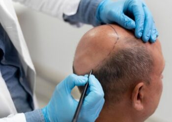 Injerto capilar: recupera tu cabello con resultados óptimos
