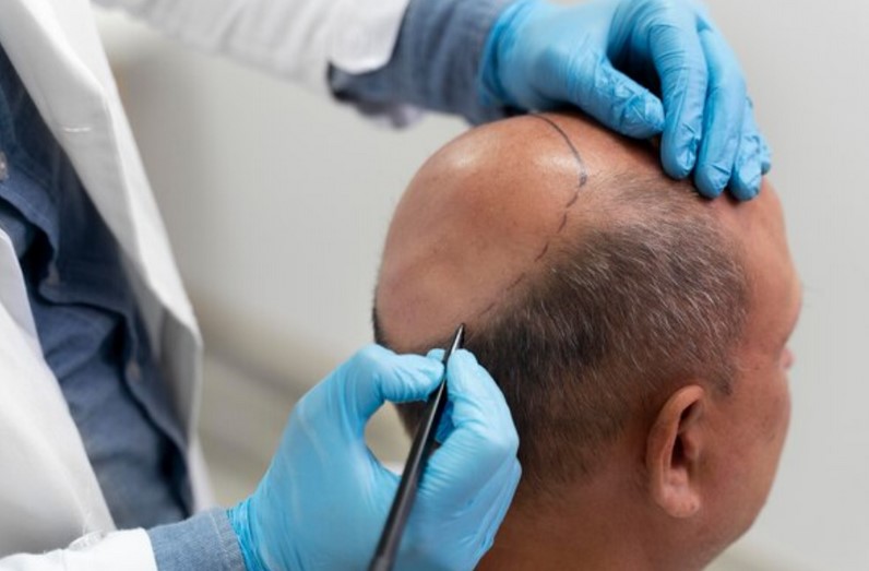 Injerto capilar: recupera tu cabello con resultados óptimos