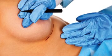 ¿Cómo elegir el procedimiento de cirugía plástica más adecuado según tu cuerpo?